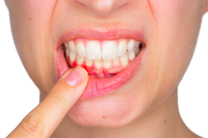 What is Gum Disease