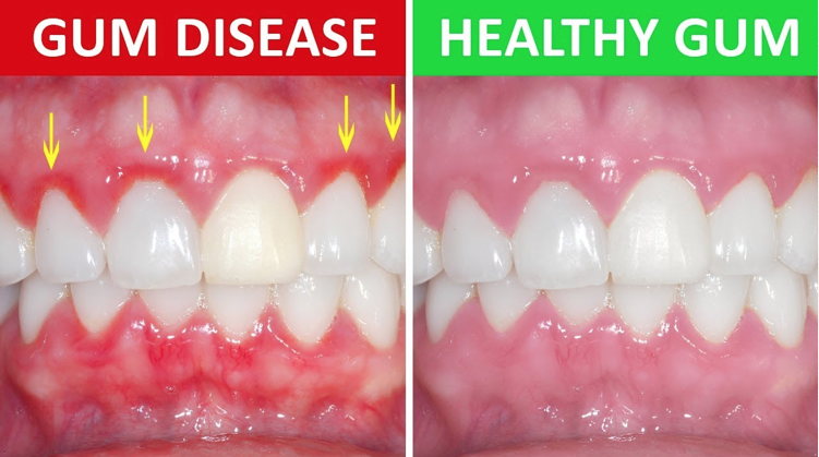 Gum disease leads to stroke
